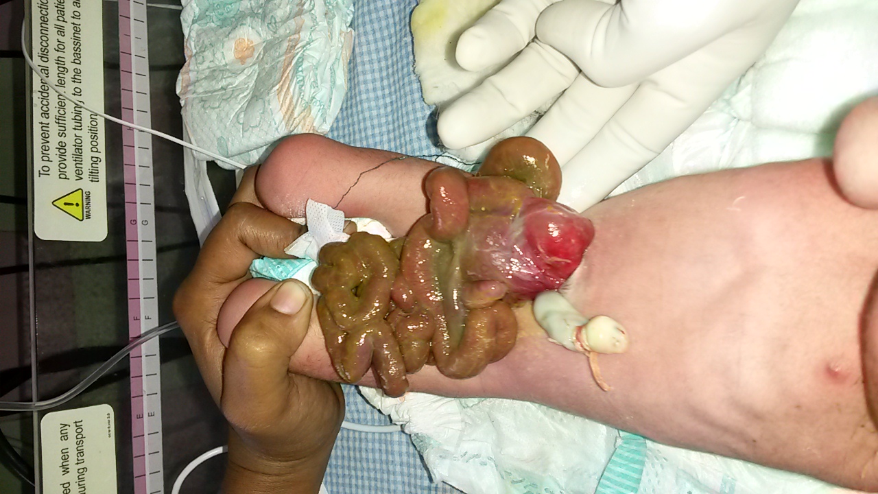 Pediatric G.I. Surgery Image 3
